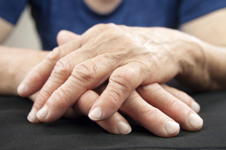 artrita reumatoidă a degetelor