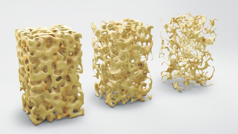 Osteoporoza, boala oaselor fragile
